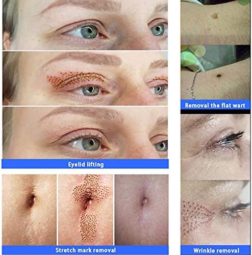 Micro Plasma Pen Skin Tightening Tag Wart Mole Removers Kit Tattoo Dark Spot Freckle Removal Skin